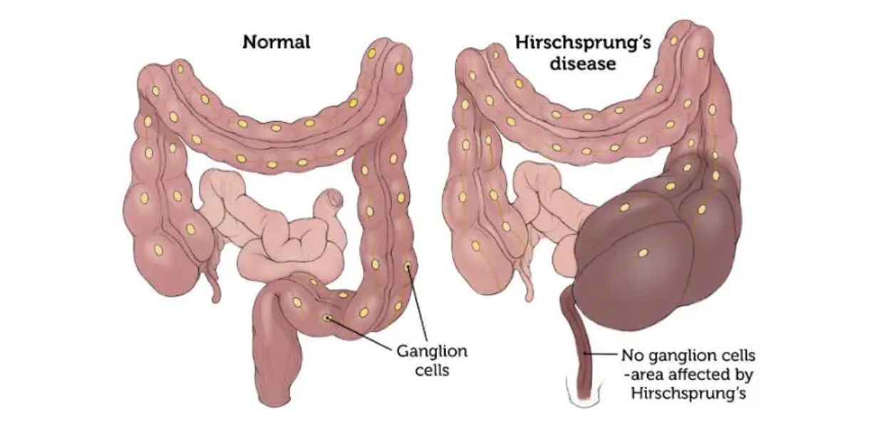 Hirschsprung Disease: Understanding, Diagnosis, and Treatment