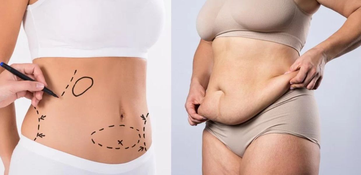 Liposuction in India