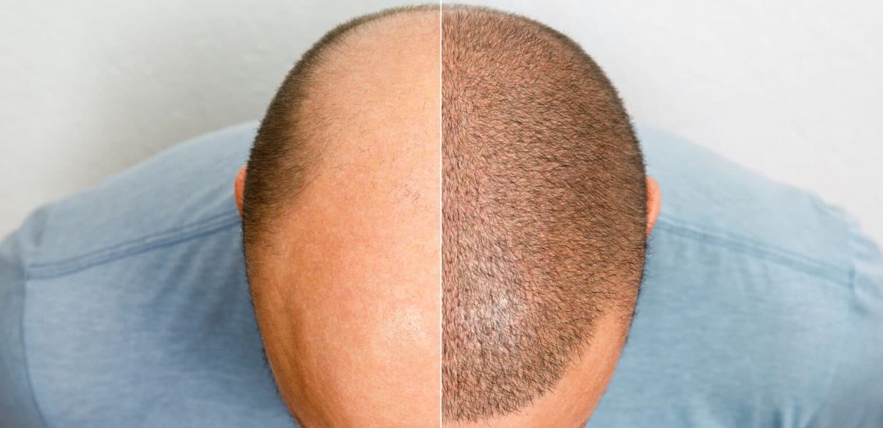 Hair Transplant