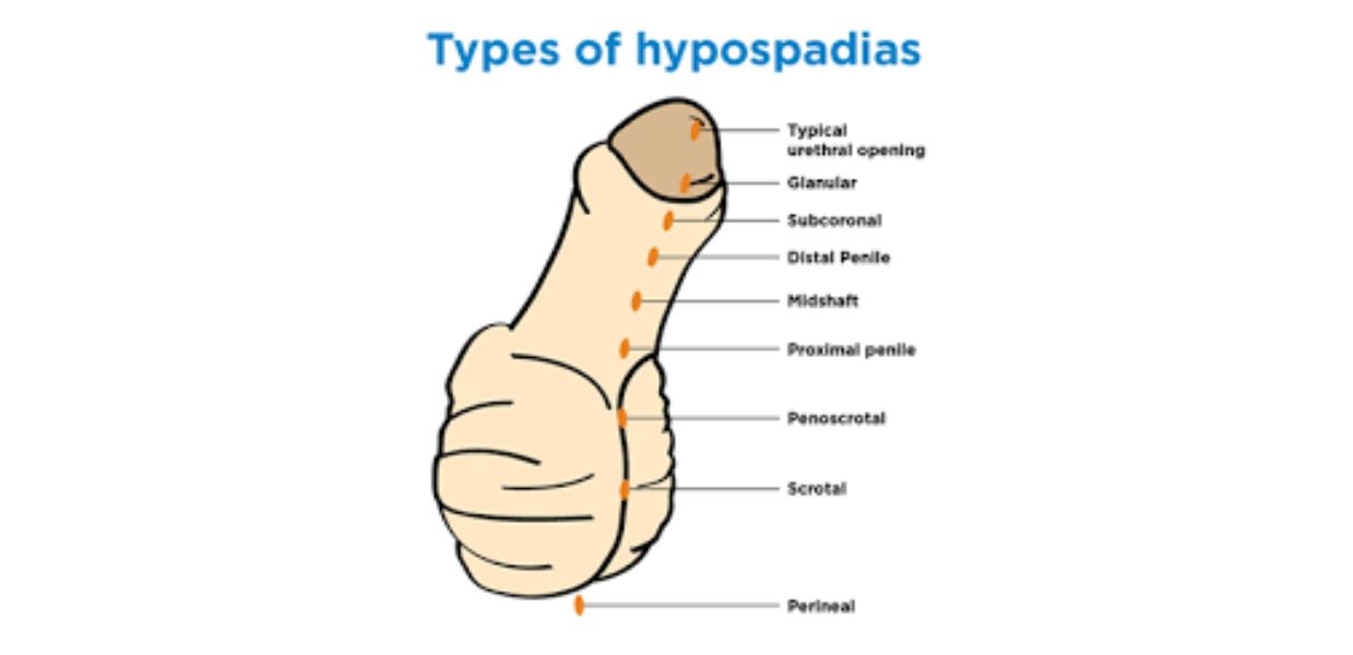 Age Considerations: Ideal Time for Hypospadias Repair
