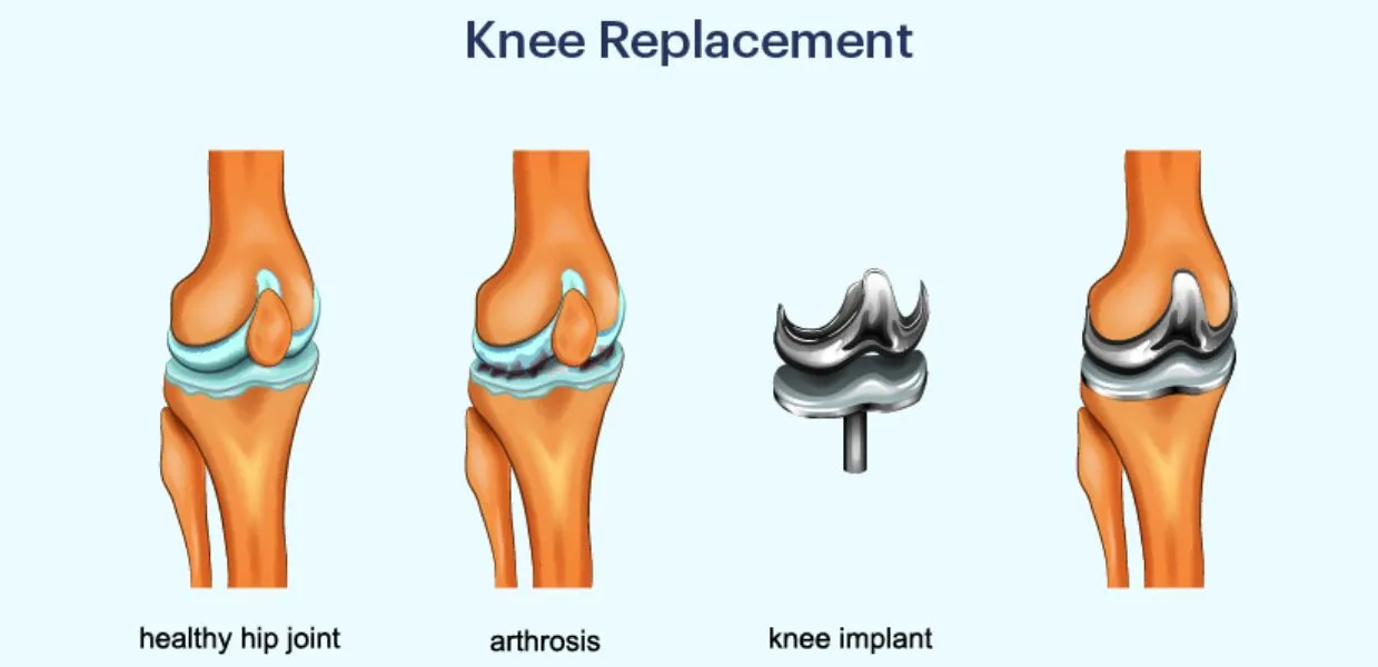 Knee Replacement Surgery