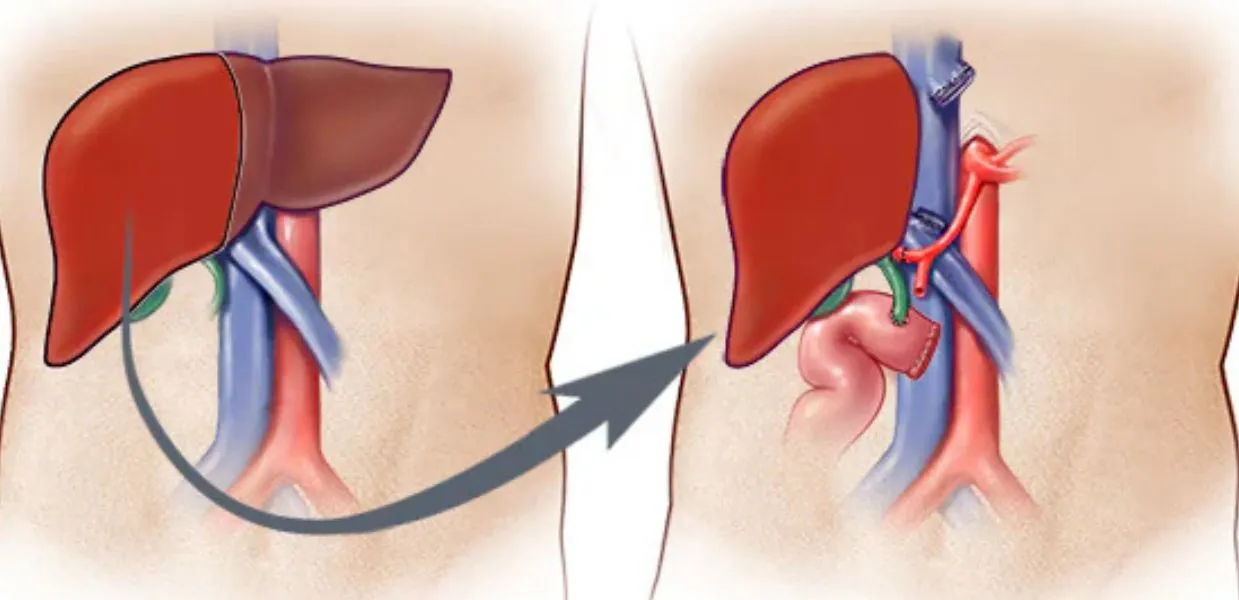 Liver Transplant 