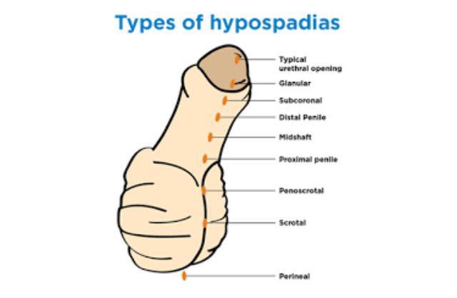 Age Considerations: Ideal Time for Hypospadias Repair