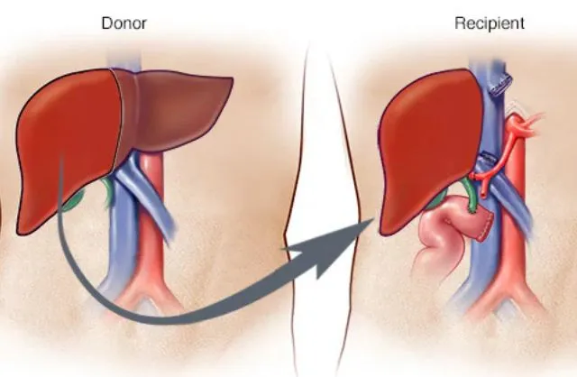 Liver Transplant 