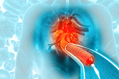 Angioplasty Angioplasty 
