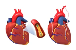 CABG