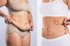 Liposuction