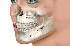 Maxillofacial Surgery