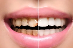 mouth-rehabilitation