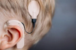 Cochlear Implant Surgery