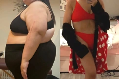 Weight loss Surgery