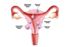 Uterine Fibroids