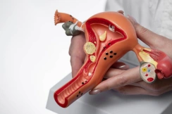 Uterus Removal