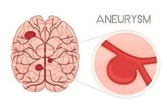  Brain Aneurysm Surgery 
