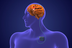 Deep Brain Stimulation