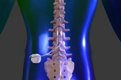 Spinal Cord Stimulation (SCS)