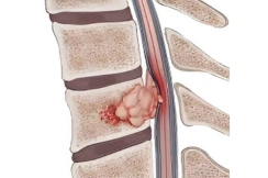 Spinal Cord Tumor