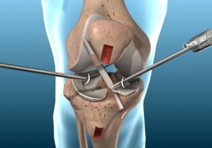 Arthroscopy