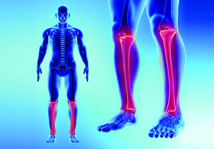 Limb Lengthening Surgery 
