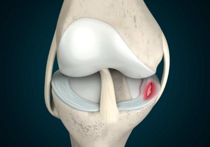 meniscus-tear