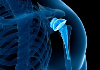 Shoulder Replacement