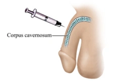 Erectile Dysfunction Stem Cell