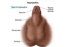 hypospadias