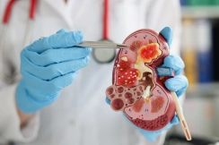 kidney stone