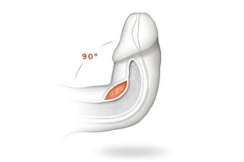 Penile curvature