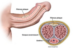 peyronie's disease 