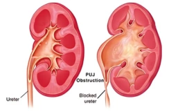 PUJ obstruction