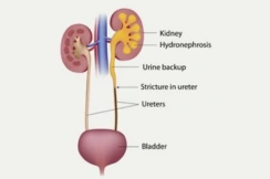 Stricture Urethra