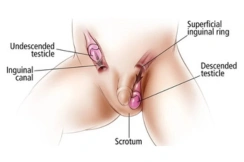 Undescended testis