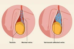 varicocele