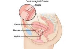 VVF Repair